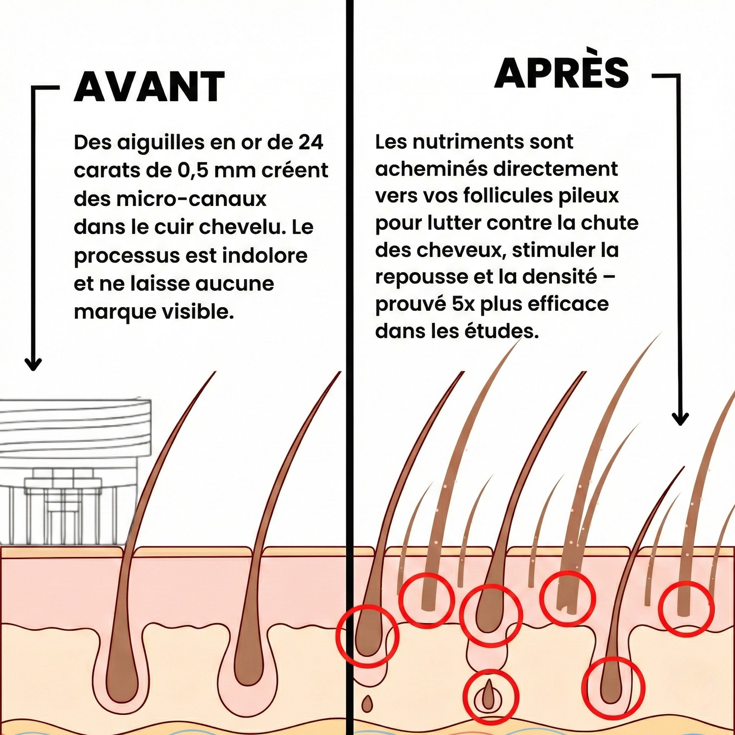 AuraHair™ Système de Repousse des Cheveux