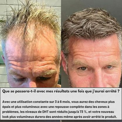 AuraHair™ Système de Repousse des Cheveux